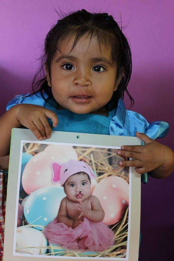 Guatemalteeks kindje dat door de stichting T.E.S.S. Unlimited geopereerd is.